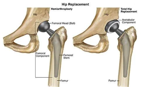 computer_assisted_knee_replacement Computer Navigated Partial Knee Replacement India