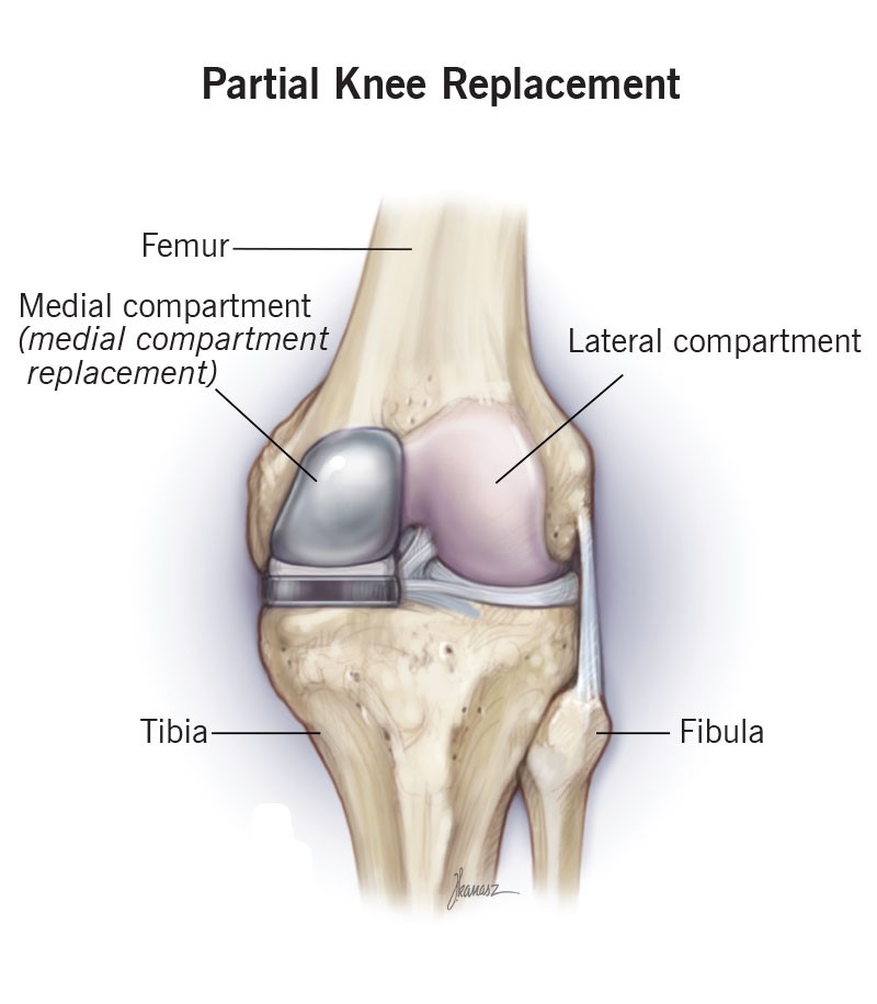 hip_replacement_surgery Best Hip Replacement Doctor in Jaipur, India
